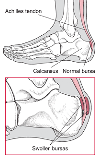 Bursitis in the Heel