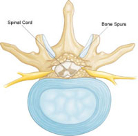 Spinal stenosis