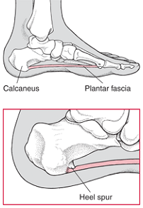 What Is a Heel Spur