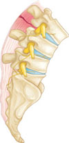 ligament Tear