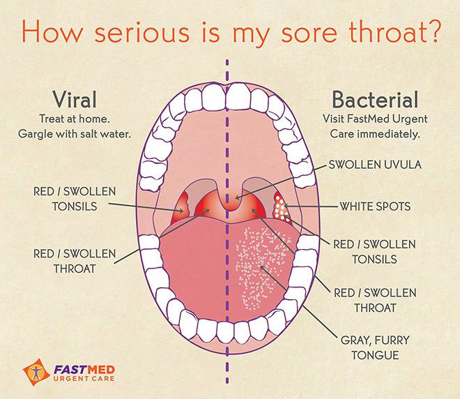 ¿Cómo saber si tienes una infección en la garganta?